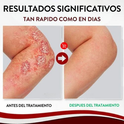 PielLibre™ 2x1 – Spray Anti-Psoriasis