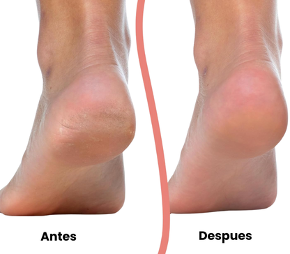 CalloFix™ Removedor de Callos Eléctrico - [PROMOCIÓN DISPONIBLE SOLO HOY]